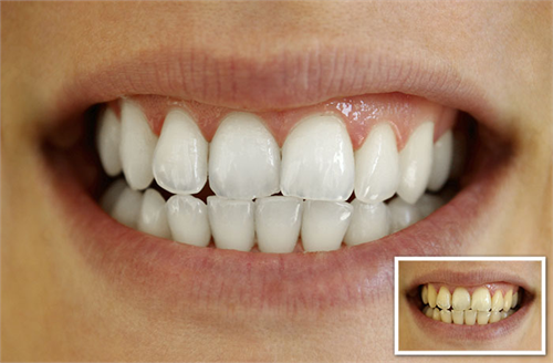 Ý nghĩa của việc Cạo vôi và vệ sinh răng. Làm thế nào để ngăn chặn và loại bỏ mảng bám và vôi răng?
