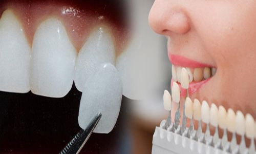 Dịch vụ phục hình thẩm mỹ răng sứ VENEER tại Nha khoa bsloan: