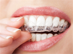 Tẩy trắng và bọc sứ – nên làm trắng răng bằng cách nào?