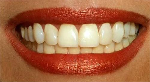 Biện pháp cải thiện răng sậm màu?