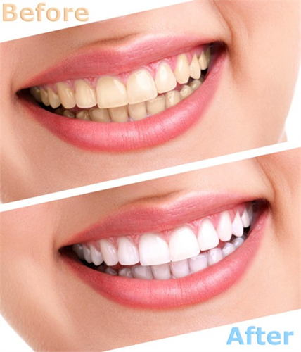 Có cách nào làm trắng răng vĩnh viễn được không?