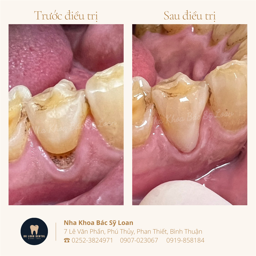 Trước và sau điều trị